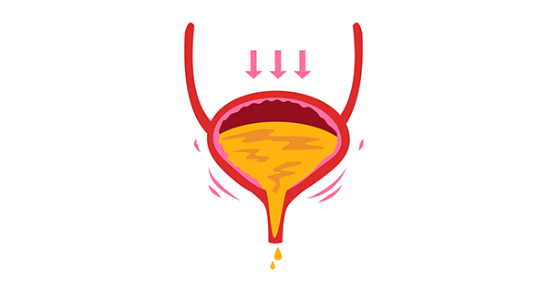 Stress Urinary Incontinence in Women