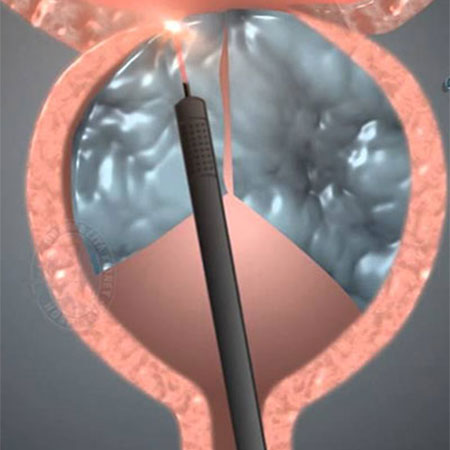 Holmium Laser Prostatectomy in Abu Dhabi
